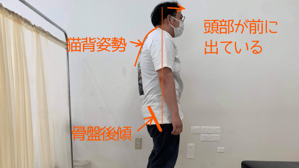 猫背姿勢の特徴