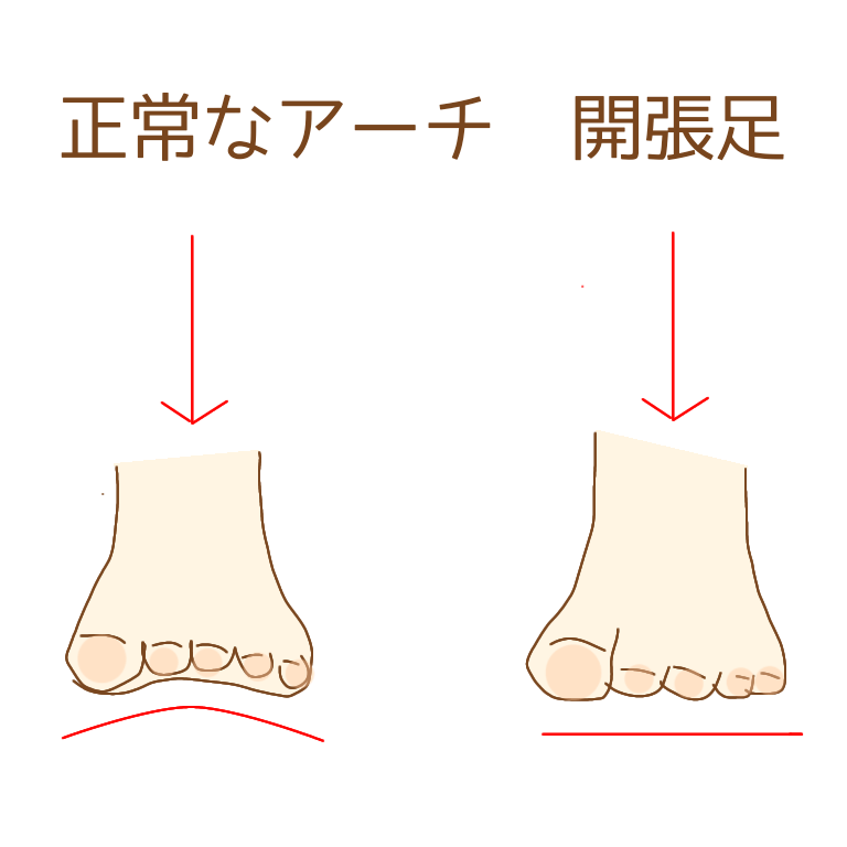 正常なアーチと開張足