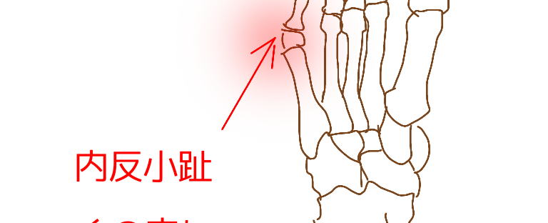 内反小趾