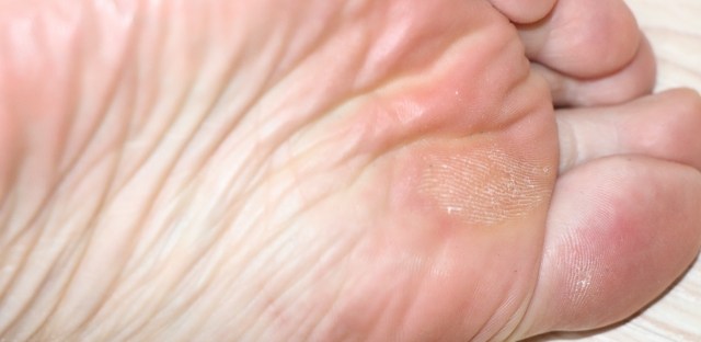 足裏第二趾のタコ