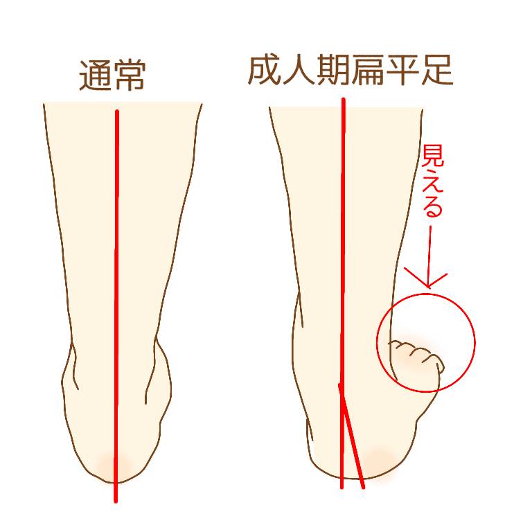 偏平足後ろから見る