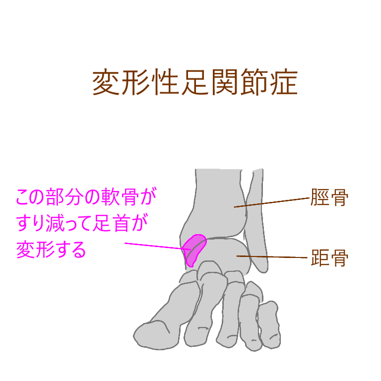 変形性足関節症