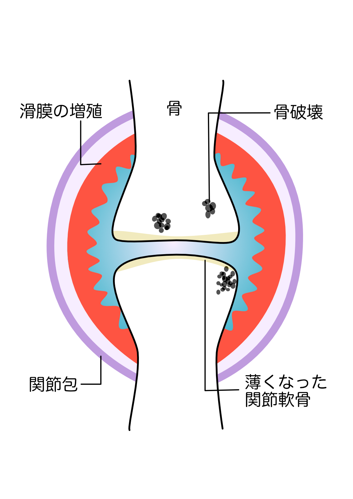 関節リウマチステージ２