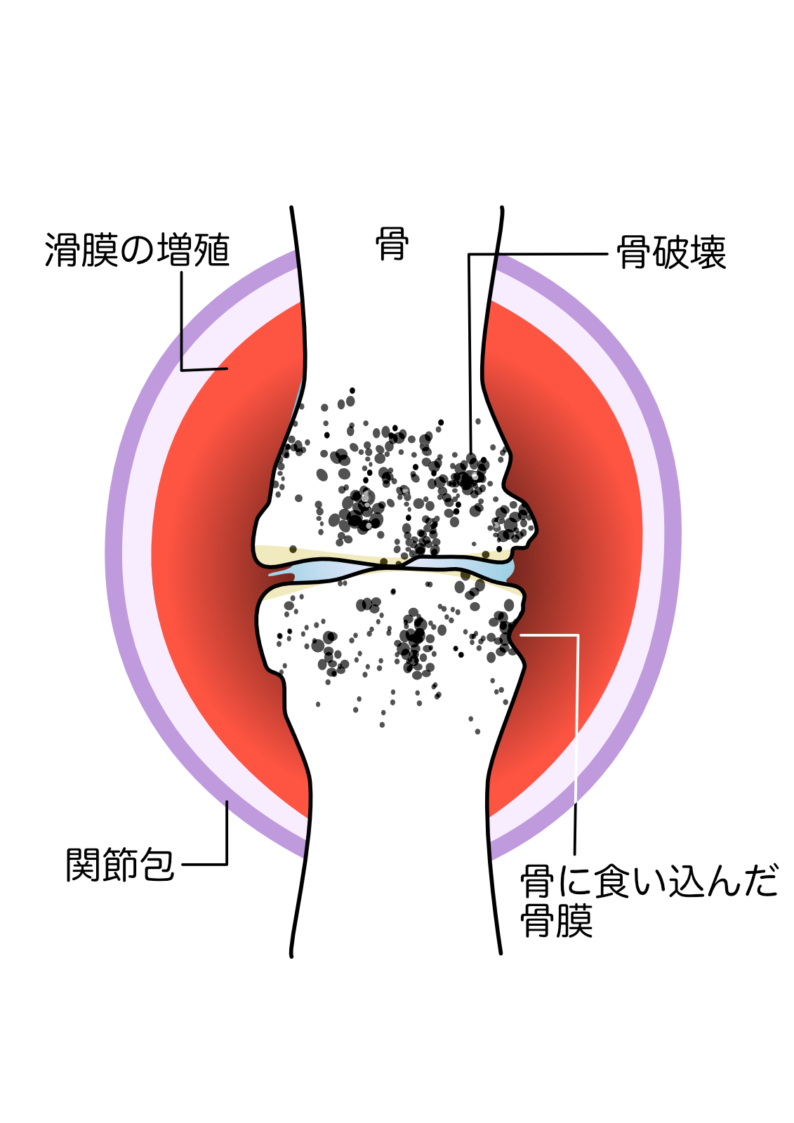 関節リウマチステージ３